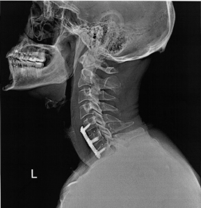 cervical-fusion-texas